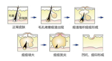 紅腫痘痘怎么快速消腫 遠離紅腫痘痘大作戰