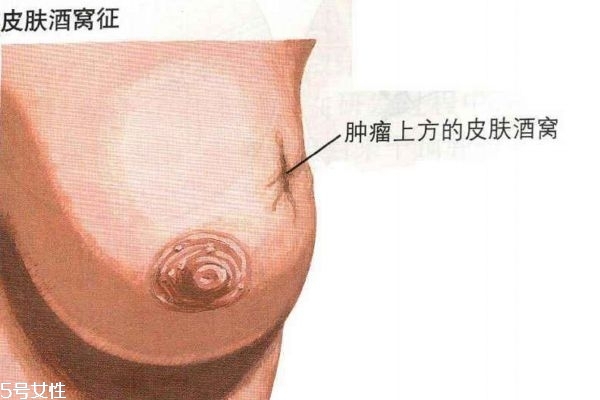 乳腺癌的早期癥狀 帶你認識乳腺癌