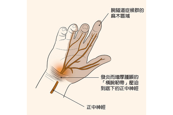 手麻每天4動作 解決神經壓迫