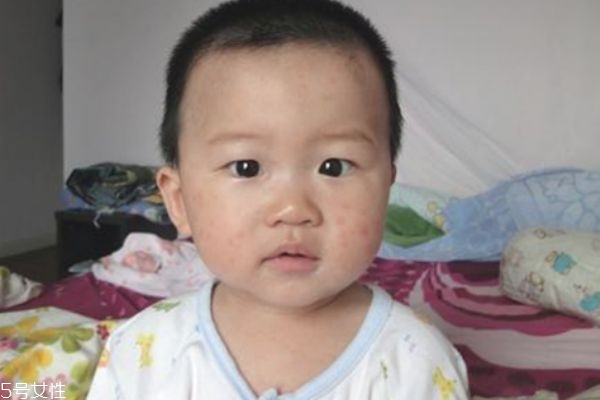 幼兒急疹發燒怎么辦 幼兒急疹典型的特點