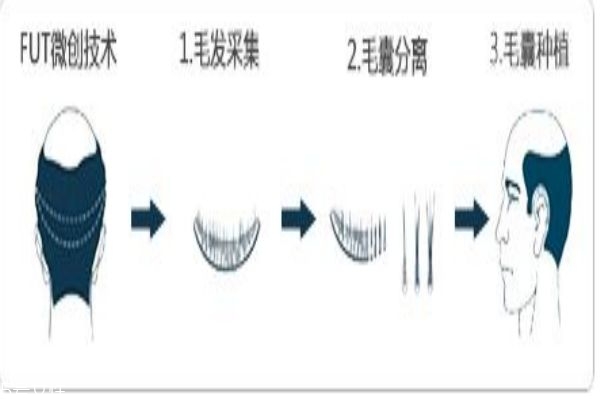 植發疼嗎 植發的步驟