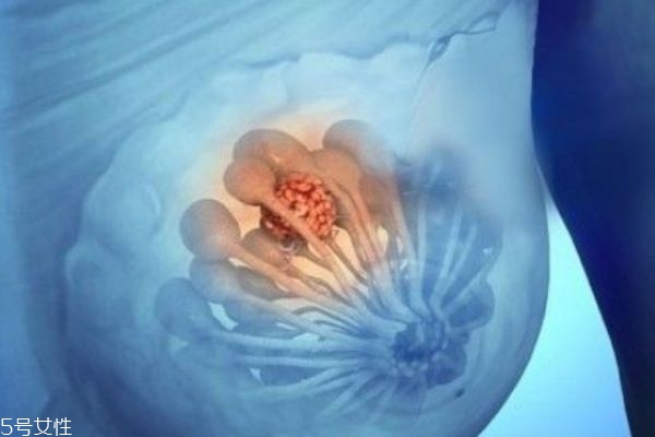 乳腺增生是怎么形成的 乳腺增生不治會怎樣