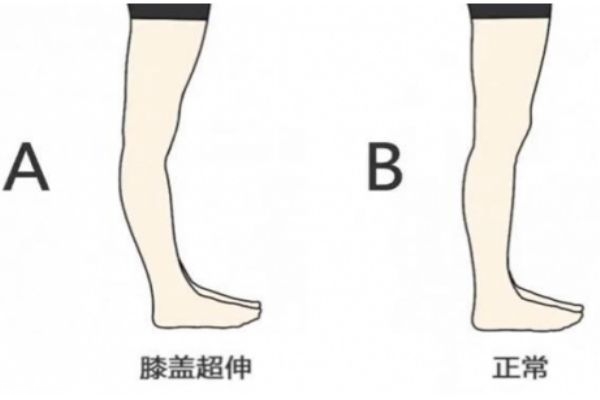 膝關節超伸的危害 會導致以下疾病