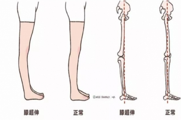 膝關節超伸的危害 會導致以下疾病