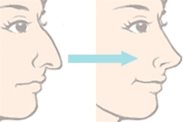 鷹鉤鼻矯正手術要多長時間 鷹鉤鼻整形手術時長