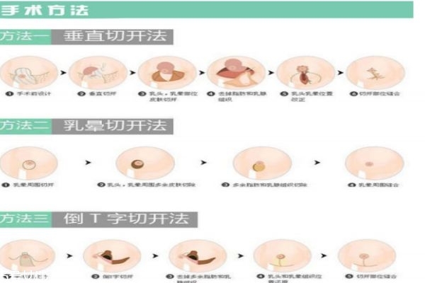 縮胸手術是什么 為什么要做縮胸手術