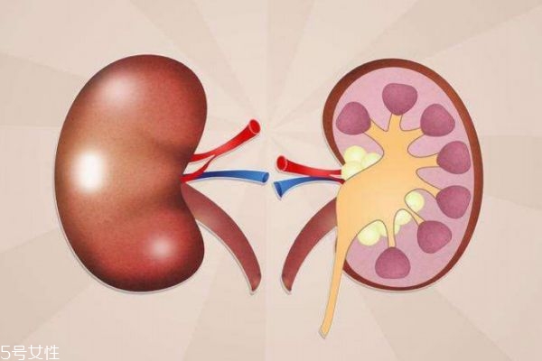 腎結石平常注意什么 腎結石飲食禁忌