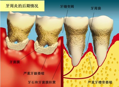 牙周炎要拔牙齒嗎 牙周炎要注意什么