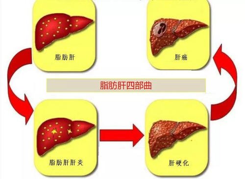 脂肪肝患者一點肉都不能吃嗎 脂肪肝適合高蛋白嗎