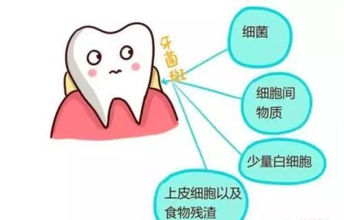 飯后多久用簌口水適合 牙結石會自己掉嗎