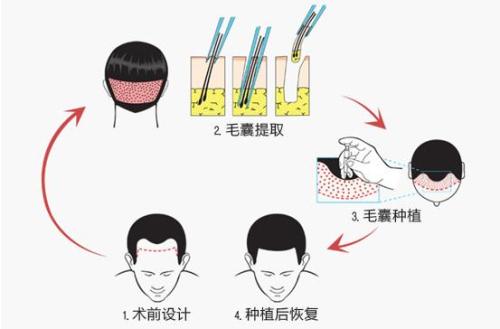 自體毛發種植多少錢 自體毛發種植哪一步最關鍵