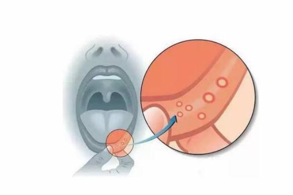 口腔潰瘍為什么這么疼 口腔潰瘍為什么是白的