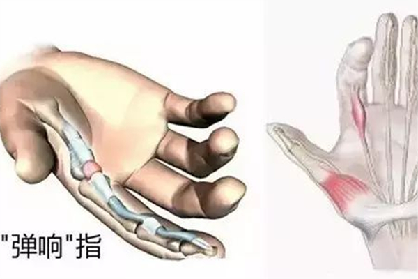 腱鞘炎對身體有什么危害 腱鞘炎對生活有影響嗎