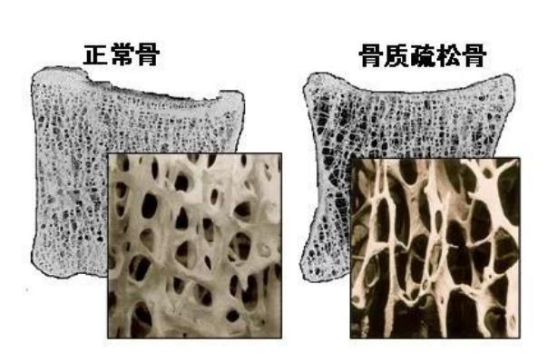 骨質疏松有哪些癥狀表現 骨質疏松怎么治才能徹底治好