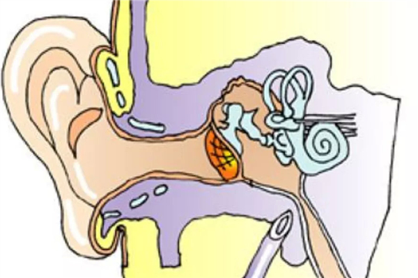 中耳炎會耳鳴嗎 中耳炎會引起什么癥狀