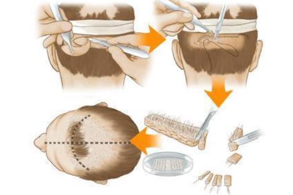 植發是用自己的頭發移植嗎 植發的危害和后遺癥