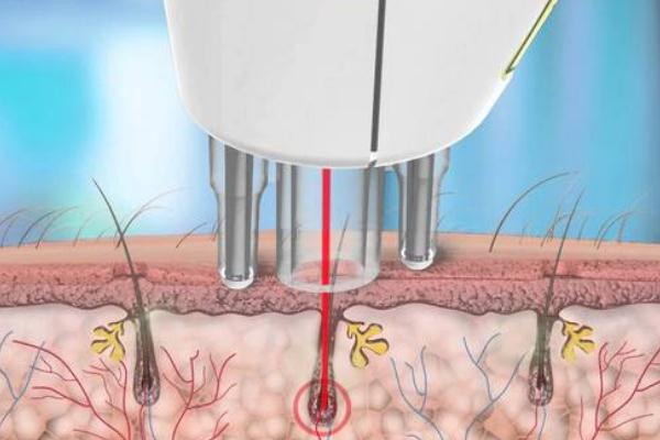 激光脫毛和冰點脫毛有什么區別 激光脫毛有什么后遺癥