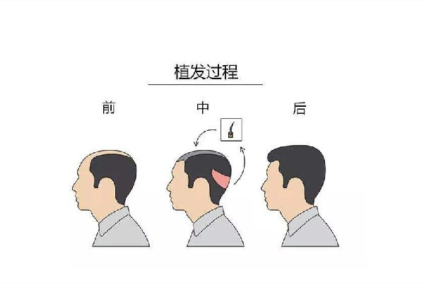 植發需要多少錢 植發按什么標準收費