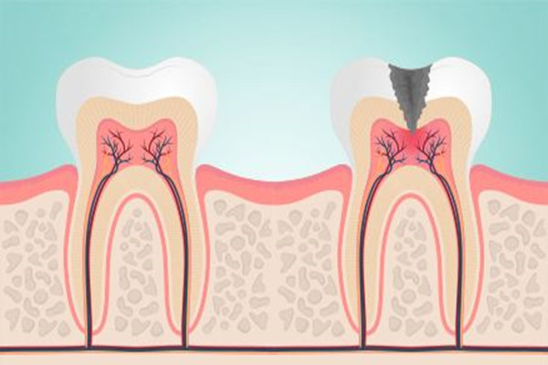牙齒敏感會導致牙髓炎嗎 牙齒敏感的危害
