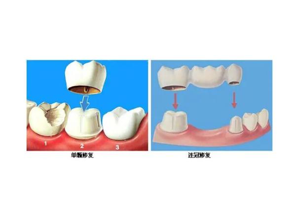 鑲牙是怎么固定的 鑲牙是固定的好還是活動的好