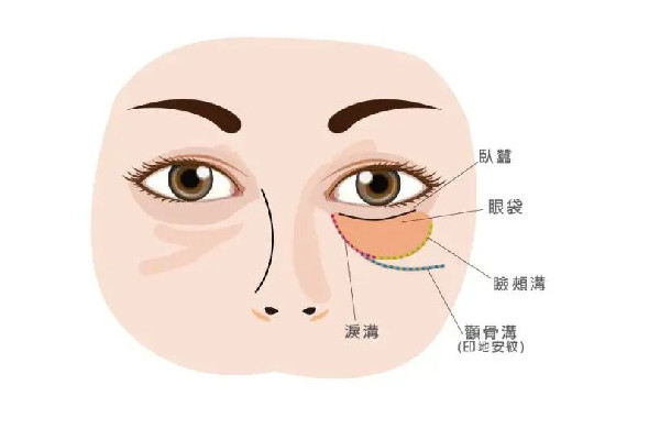 填淚溝填成眼袋怎么辦 填淚溝會不會造成失明