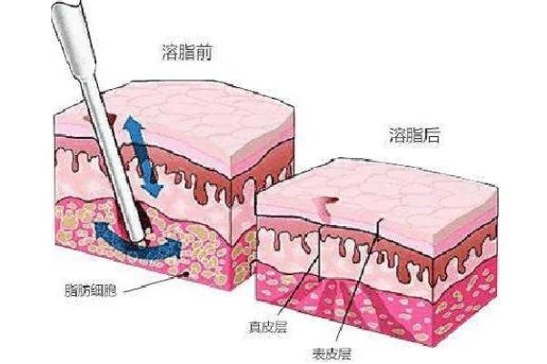 溶脂針會導致皮膚松弛嗎 溶脂針會影響月經嗎