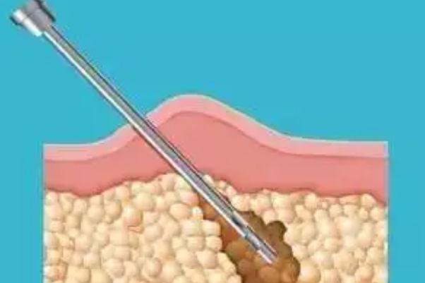 溶脂針的效果和副作用 溶脂針價格多少錢一針