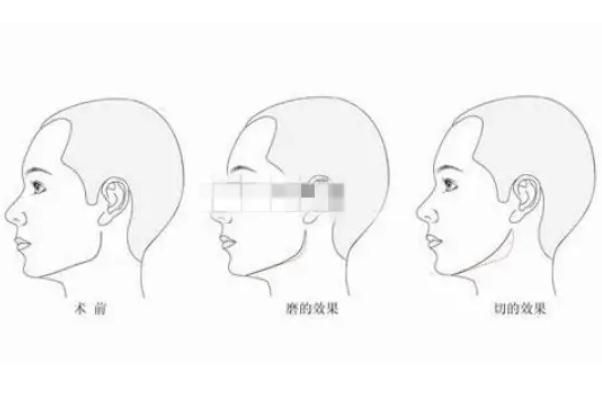 顴骨內推的釘子需要取出嗎 顴骨內推是幾級手術