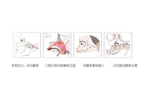 顴骨內推的釘子需要取出嗎 顴骨內推是幾級手術