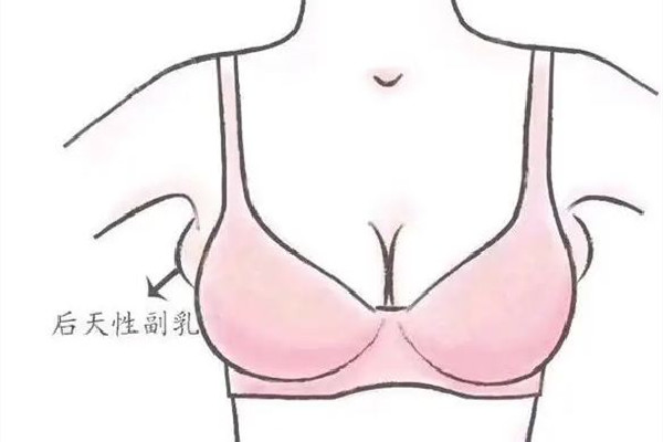 副乳切除手術是全麻還是局麻 副乳切除手術后多久可以正?；顒?></p><h3>副乳切除手術可以進醫保嗎</h3><p>副乳手術醫保能不能報銷，要看副乳腺到底是屬于什么情況，比如像病理型的副乳腺手術，副乳腺里面長了腫瘤，或者乳腺癌。這部分病人在切除腫瘤同時把副乳腺切除，這部分的費用是可以醫保報銷的。但是純粹的并沒有其他病變，為了美容目的進行副乳手術，這部分病人醫保是不予報銷的。</p><p><br/></p> </div>
<div align=