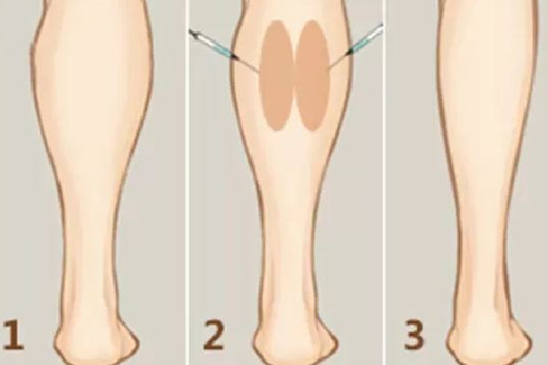 武漢打瘦腿針的醫院推薦 武漢打瘦腿針要多少錢